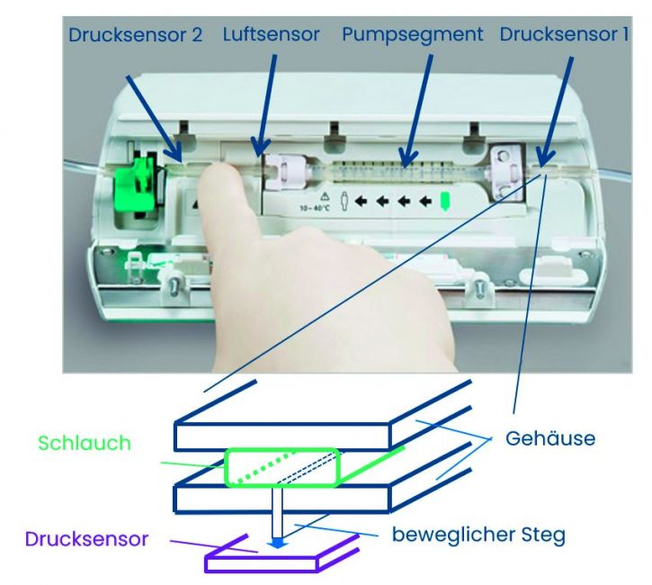 Infusionspumpe: Oben Darstellung der Pumpe und der Platzierung der Sensoren. Unten: Aufbau der Drucksensorik als Schema.
